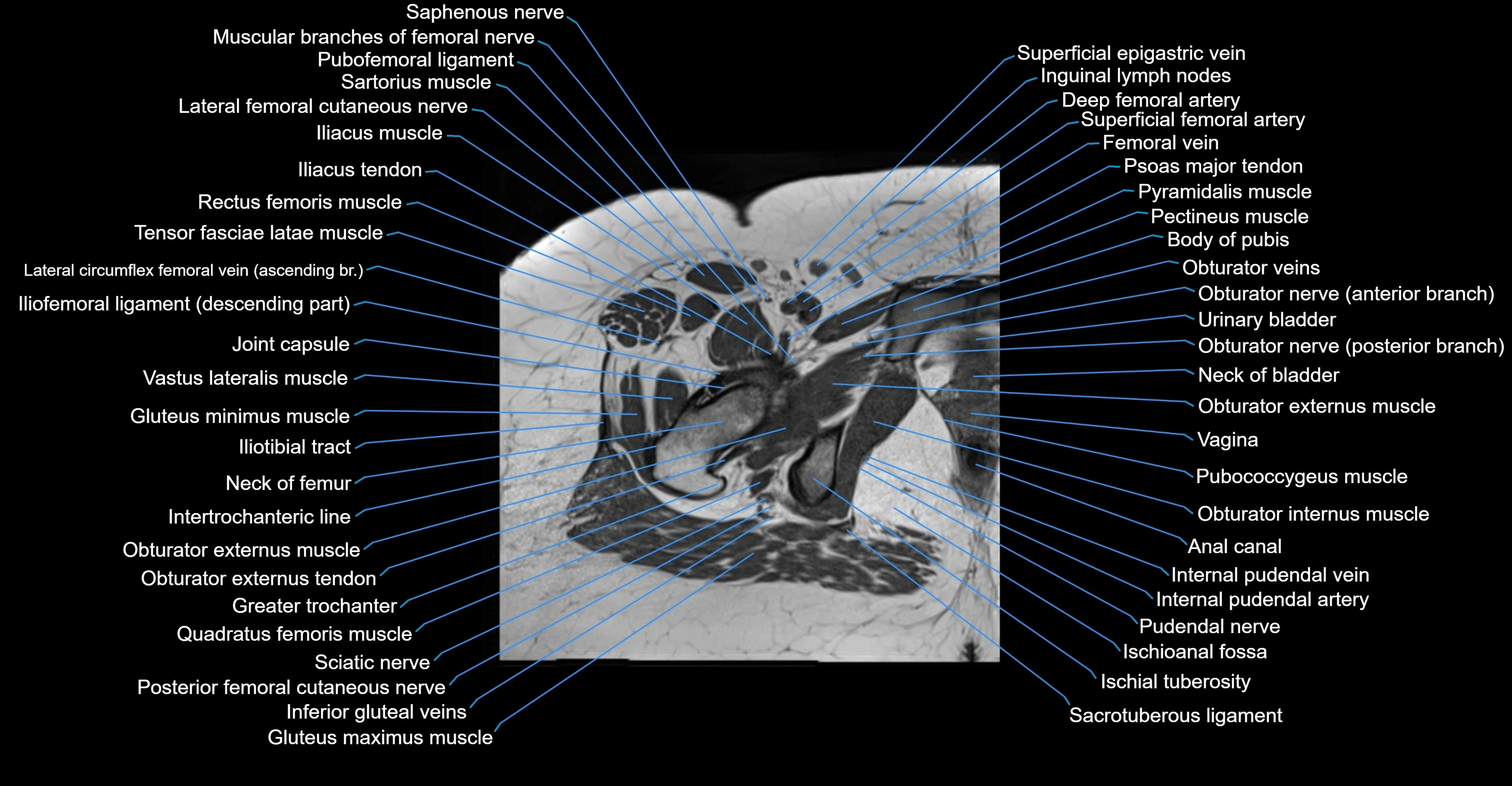 MRI hip axial cross sectional anatomy 3T 3D  radiology  anatomy image-img-00001-00049.webp